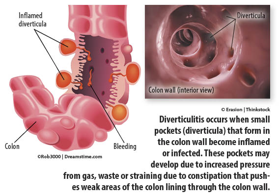 New Thinking About Acute Diverticulitis University