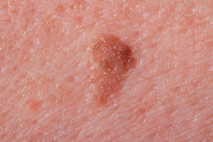 age-spots-or-signs-of-skin-cancer-university-health-news