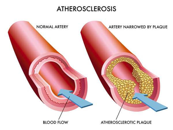 what is atherosclerosis