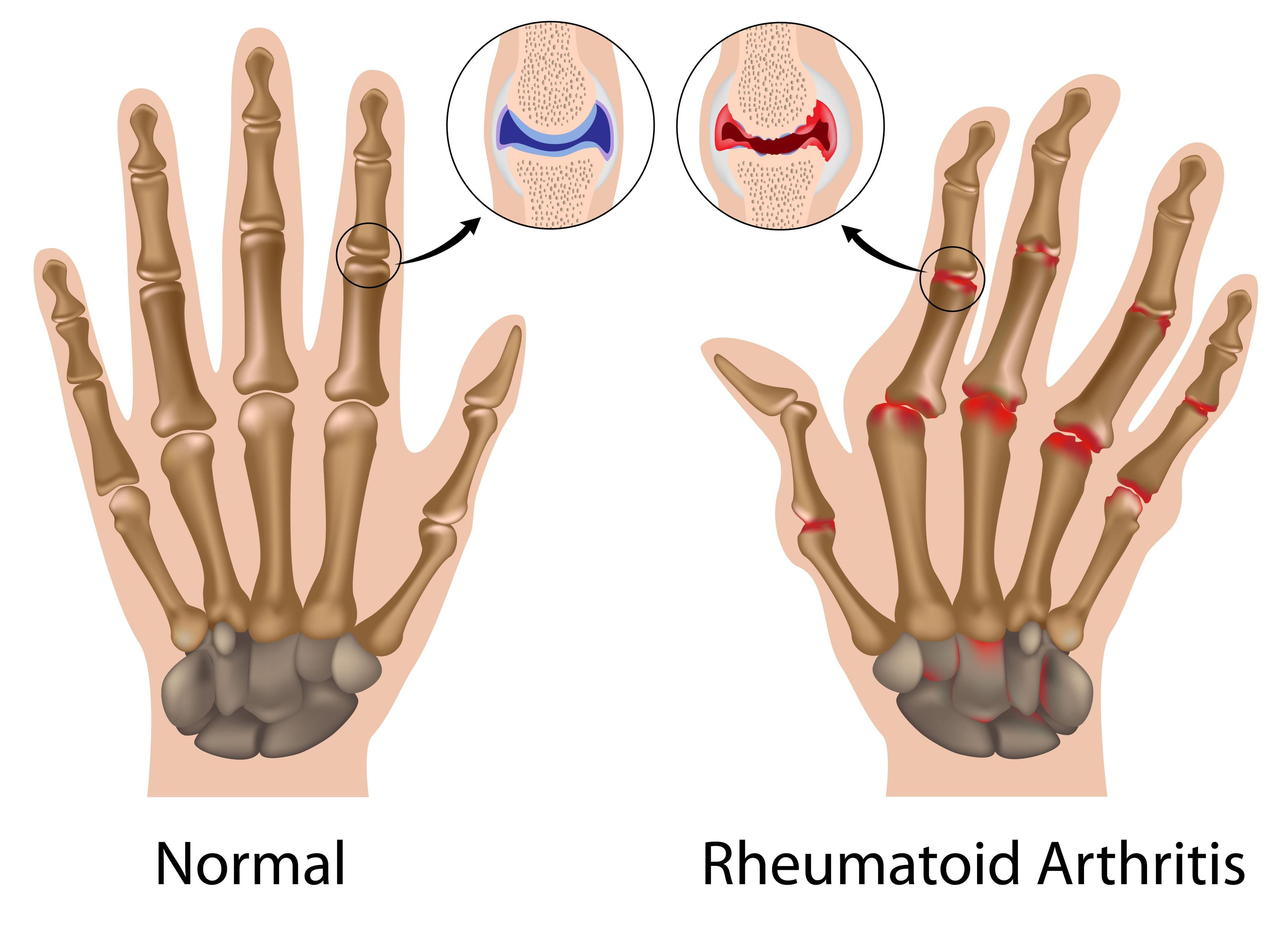 typical presentation of rheumatoid arthritis
