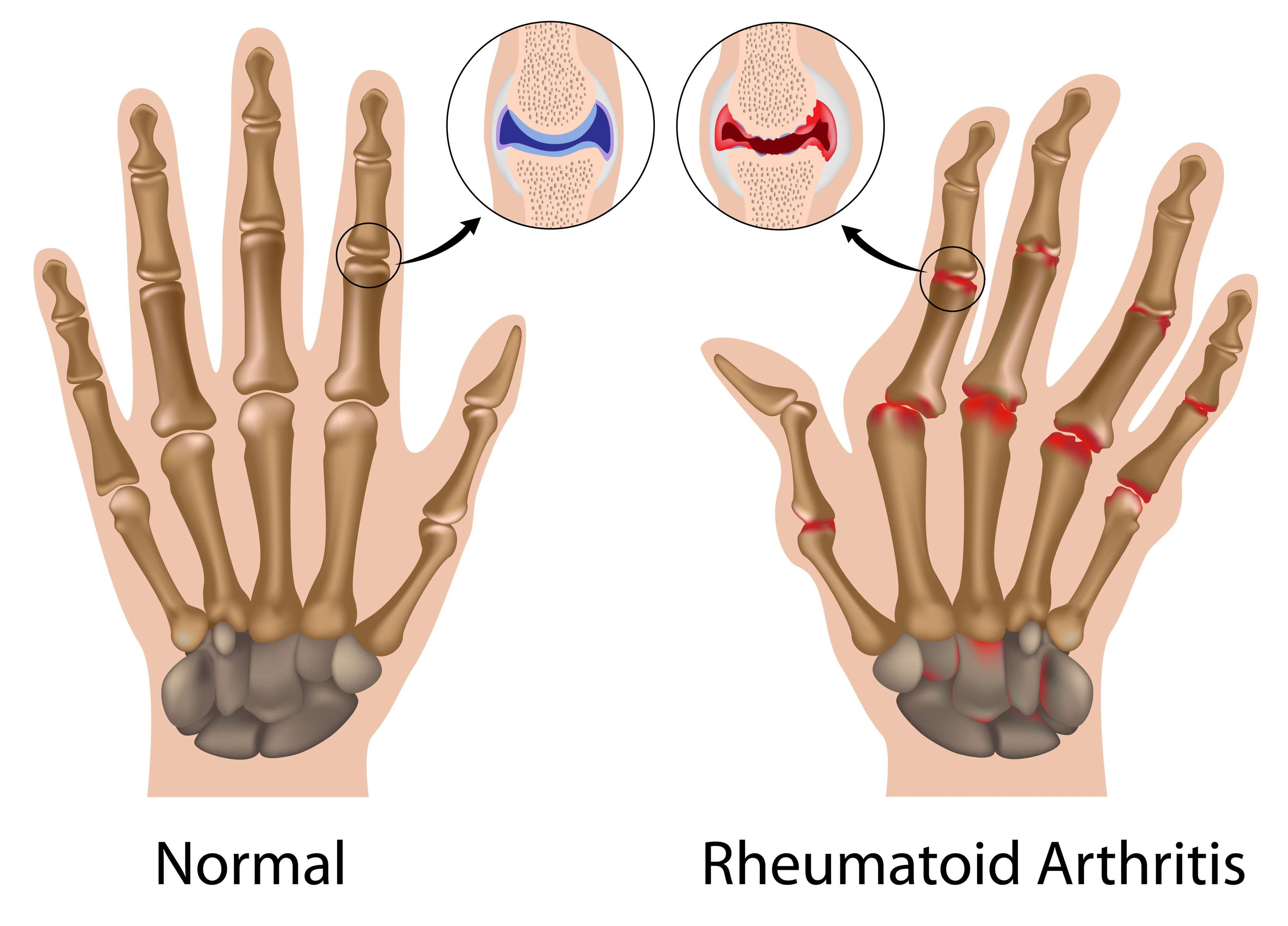 rheumatoid-arthritis-drug-methotrexate-may-elevate-a-risk-of-a