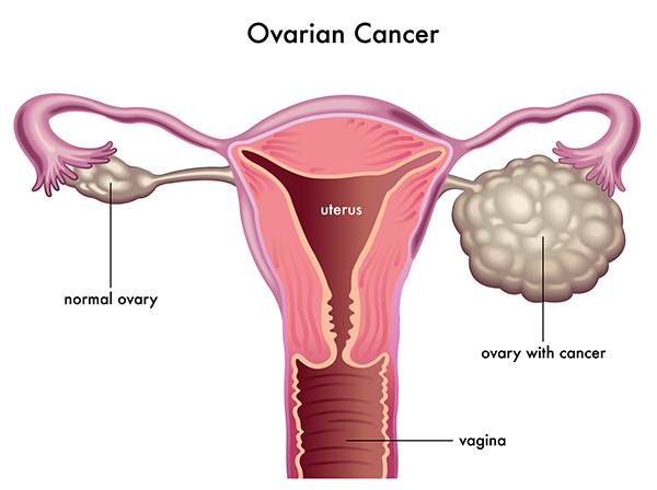 respond-quickly-to-ovarian-cancer-symptoms-university-health-news