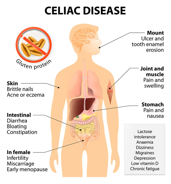 Celiac Disease Symptoms List Of 281 Ailments University Health News 