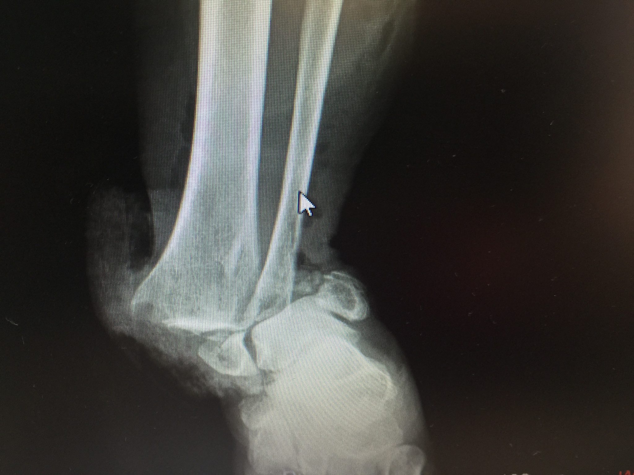 Uhn Blog Emergency Coping With A Broken Ankle Overseas University 7867