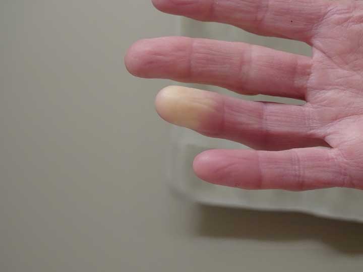Raynaud’s Disease Diagnosis and Treatments: Don’t Get Left Out in The
