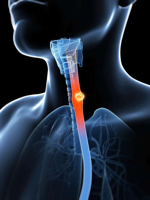 throat-cancer-symptoms-take-heed-of-these-serious-signs-university