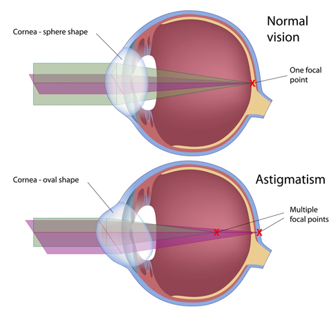 astigmatism blurry headaches blurred strain