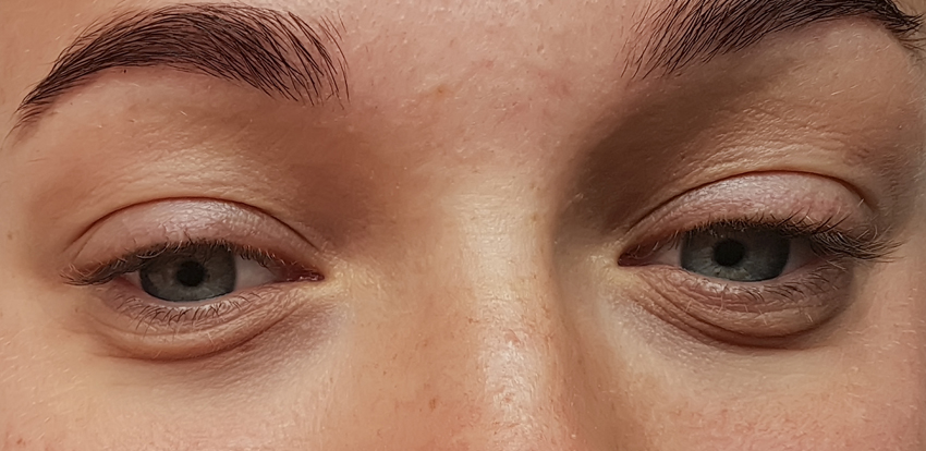 Bags Under Eyes? These Are Your Best Bets for &quot;Eye Bag&quot; Treatment - University Health News