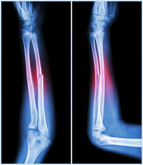 oblique bone fracture