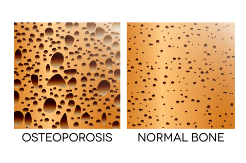 Bone density scan - feelsalo