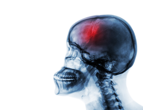 What Is Cerebrovascular Disease? - University Health News