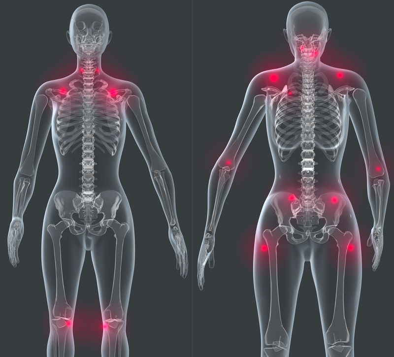 Fibromyalgia Map Of Tender Points