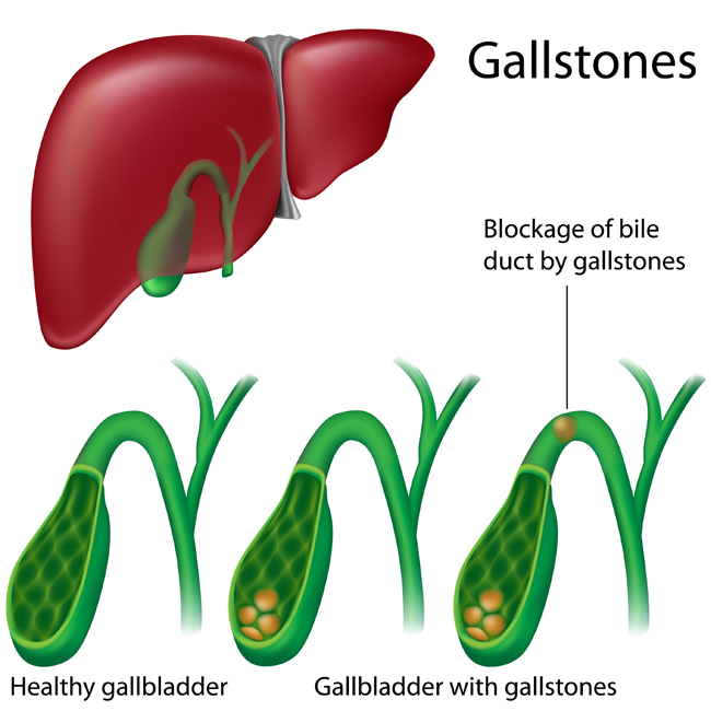 gallbladder problem