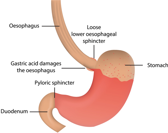 what-is-gerd-dealing-with-gastroesophageal-reflux-disease-university