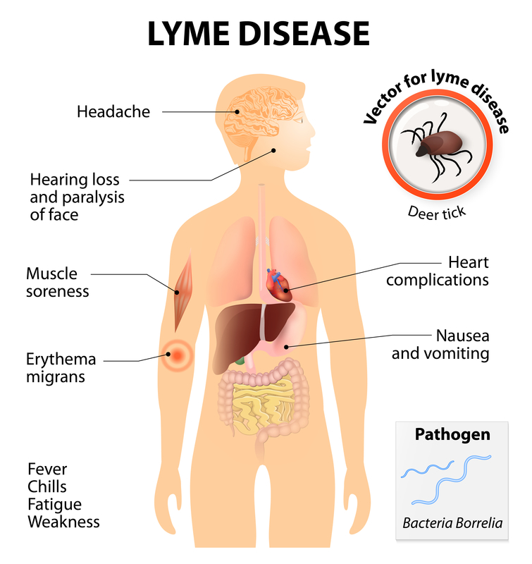 what is lyme disease