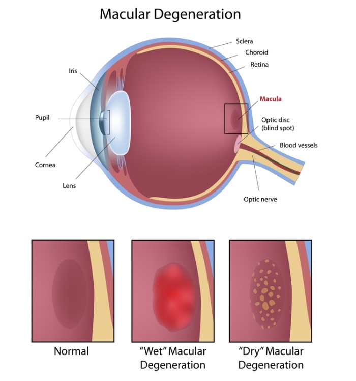 Age related macular degeneration что это