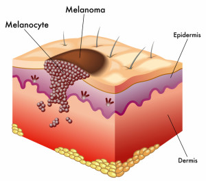 Melanomas Can Affect All Races - University Health News