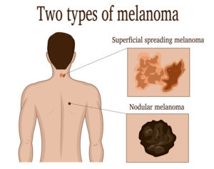 What Is Nodular Melanoma? - University Health News