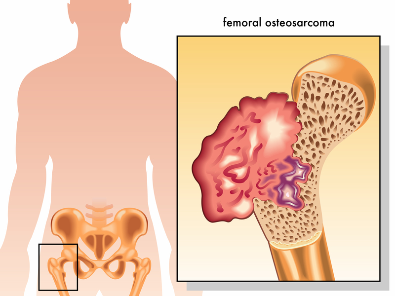 osteosarcoma-symptoms-may-point-to-a-rare-type-of-cancer-university