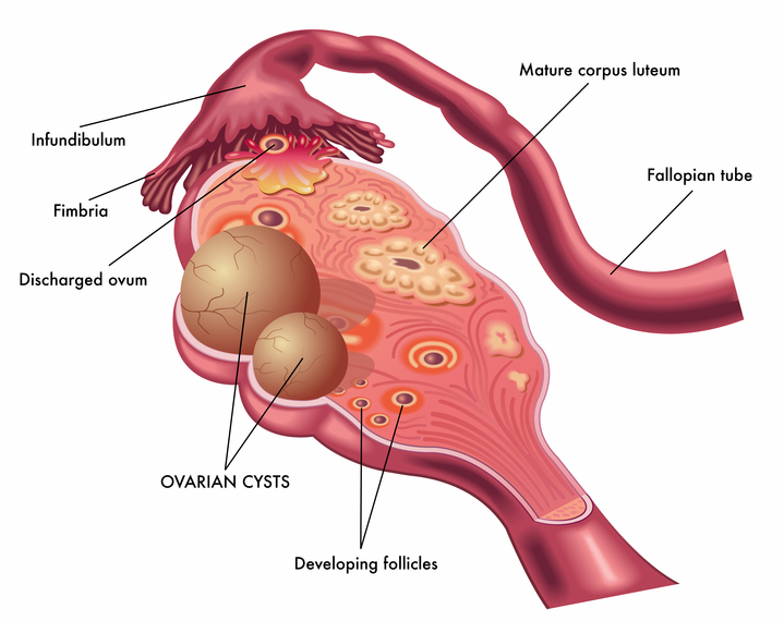 Ovarian Cyst Symptoms  How They Develop  How To Treat Them