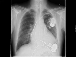 upper chest passmaker inplantation