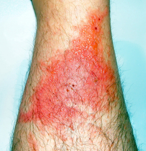 Poison Ivy: America’s Rash - University Health News