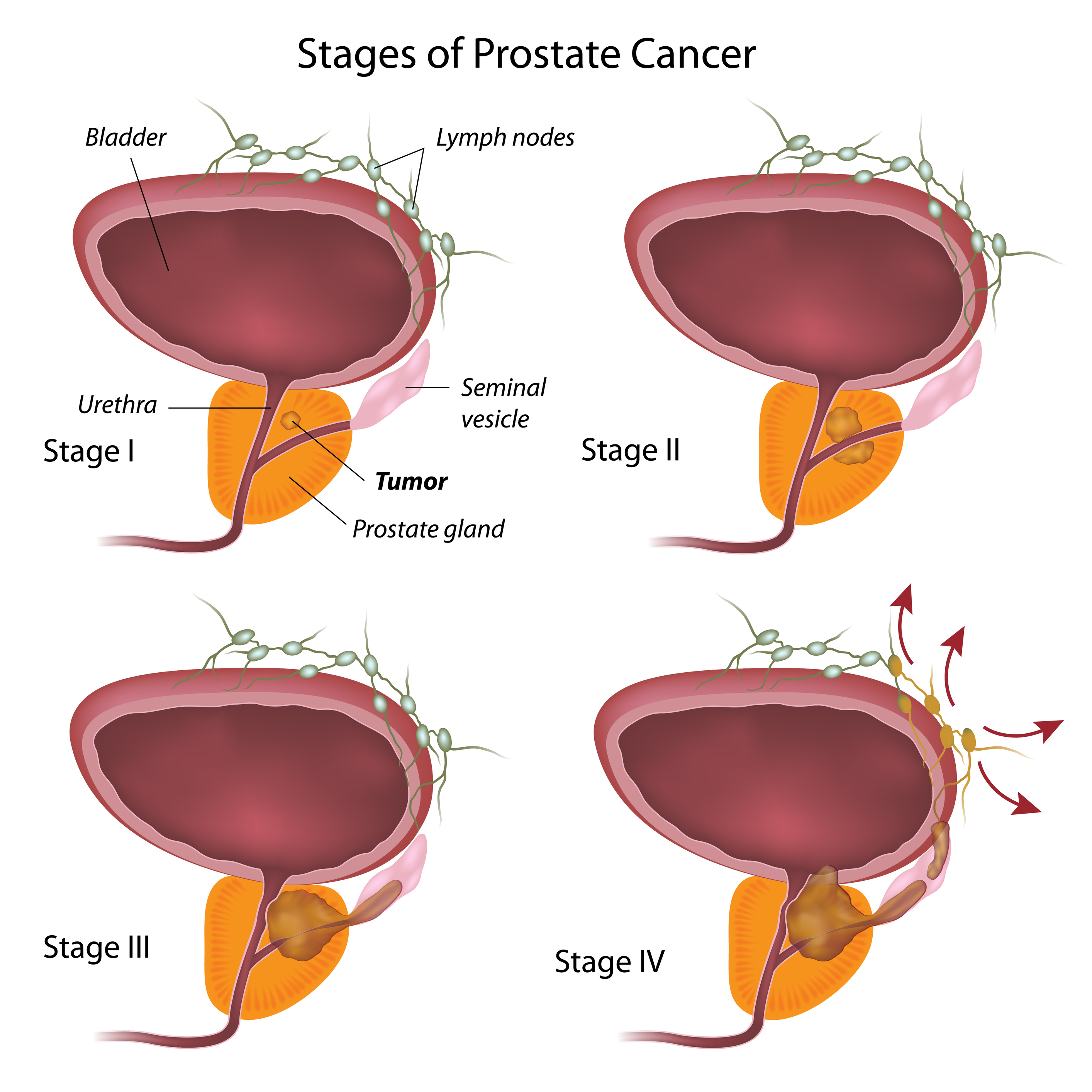 Prostate Cancer Stages 