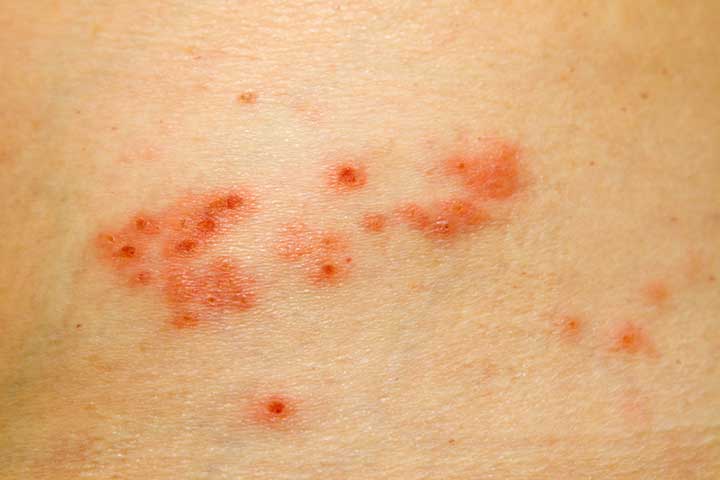 Shingles Pain 5 Myths And Facts To Set You Straight University   Shingles Pain 1 