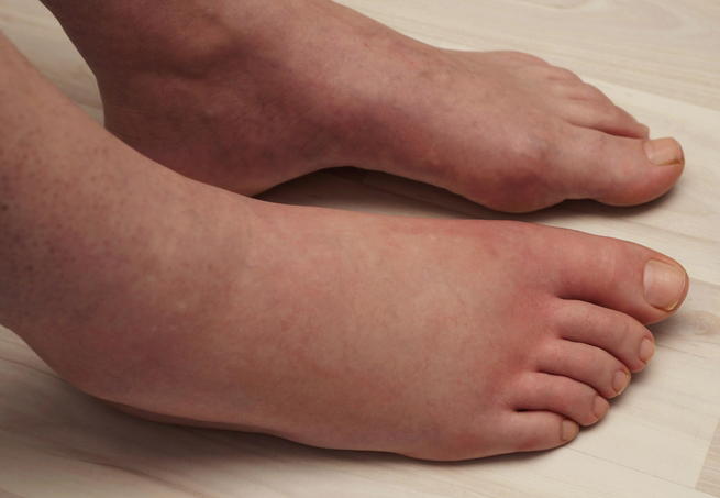 What Does Red Swollen Feet Indicate