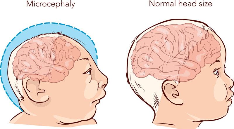 Symptoms Of Microcephaly Associated With Zika Cases